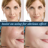 Siyinzu 2PCS Chin-Ology Double Chin Lifting Mask,Chino-logy Chi-n Mask with Hyaluronic Acid,V Line Face Lifting Ch-in Ma-sk,Face Lift Tape,Double Ch-in Reducer for Women,Collagen Face Masks Skincare
