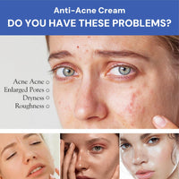 Anti Acne Face Cream,Anti A/cne Removal C/ream,Ac/ne Scar Removal Cr/eam,Dark Spot Cream,Facial Acn/e Treatment Gel,Daily Facial Moisturizer for A/cne Prone Skin,Acne Spot Treatment,Gentle Acne Cream