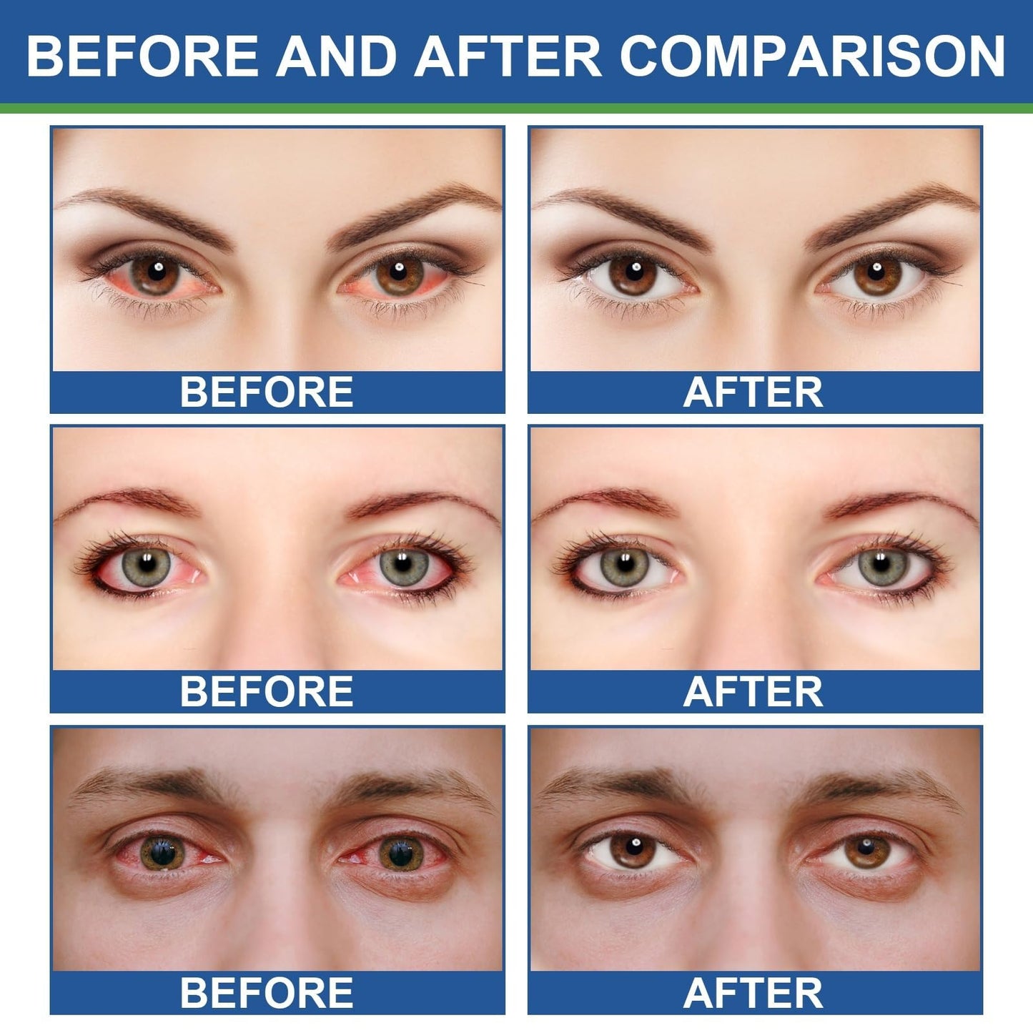 Siyinzu 2PCS Chala/zion Eye Treatment Cream,Moisturizing Cream for Eyelids,Stye Treatment for Dry Eyes,Stye E-ye Cre-am,Eye Cre-am for Dark Circles and Puffy Eyes,Hydrating Crea-m for Delicate Eye Area