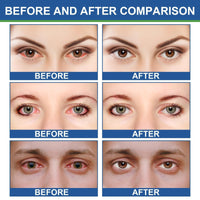 Siyinzu 2PCS Chala/zion Eye Treatment Cream,Moisturizing Cream for Eyelids,Stye Treatment for Dry Eyes,Stye E-ye Cre-am,Eye Cre-am for Dark Circles and Puffy Eyes,Hydrating Crea-m for Delicate Eye Area