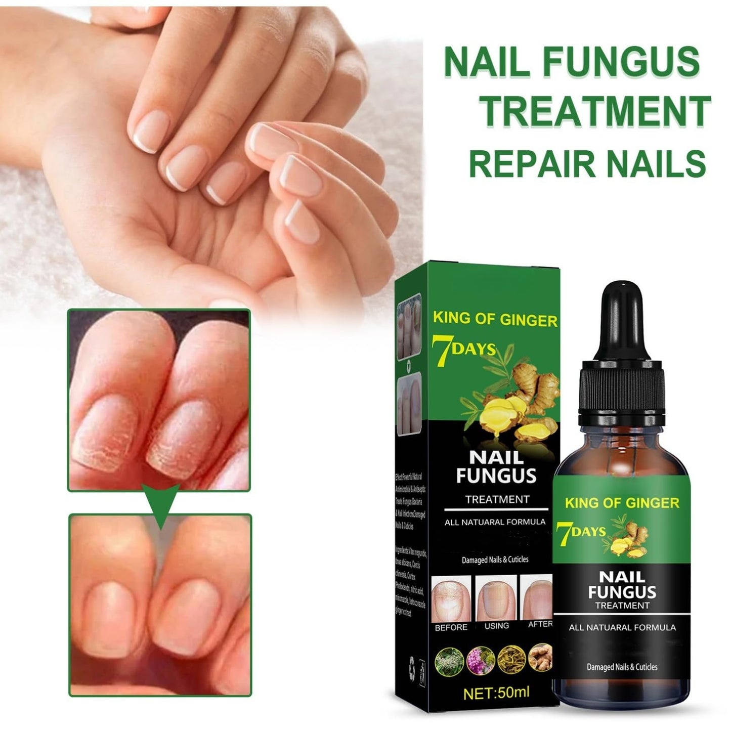 7 Days Nail Fungus Treatment,Ginger Nail Treatment,Fungal Nail Treatment,Toenail Fungus Treatment Extra Strength,Fungal Nail Treatment for Toenails Extra Strong,Nail Repair,Nail Growth Serum,50ml