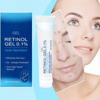 Retinol Gel,Acne Treatment Gel,Acne Control Cream for Face,Anti Acne Gel for Spot Prone Skin,Retinol Moisturizer Cream,Brightens Skin and Improves Elasticity,Face for Pimple Reduce,Without Over Drying
