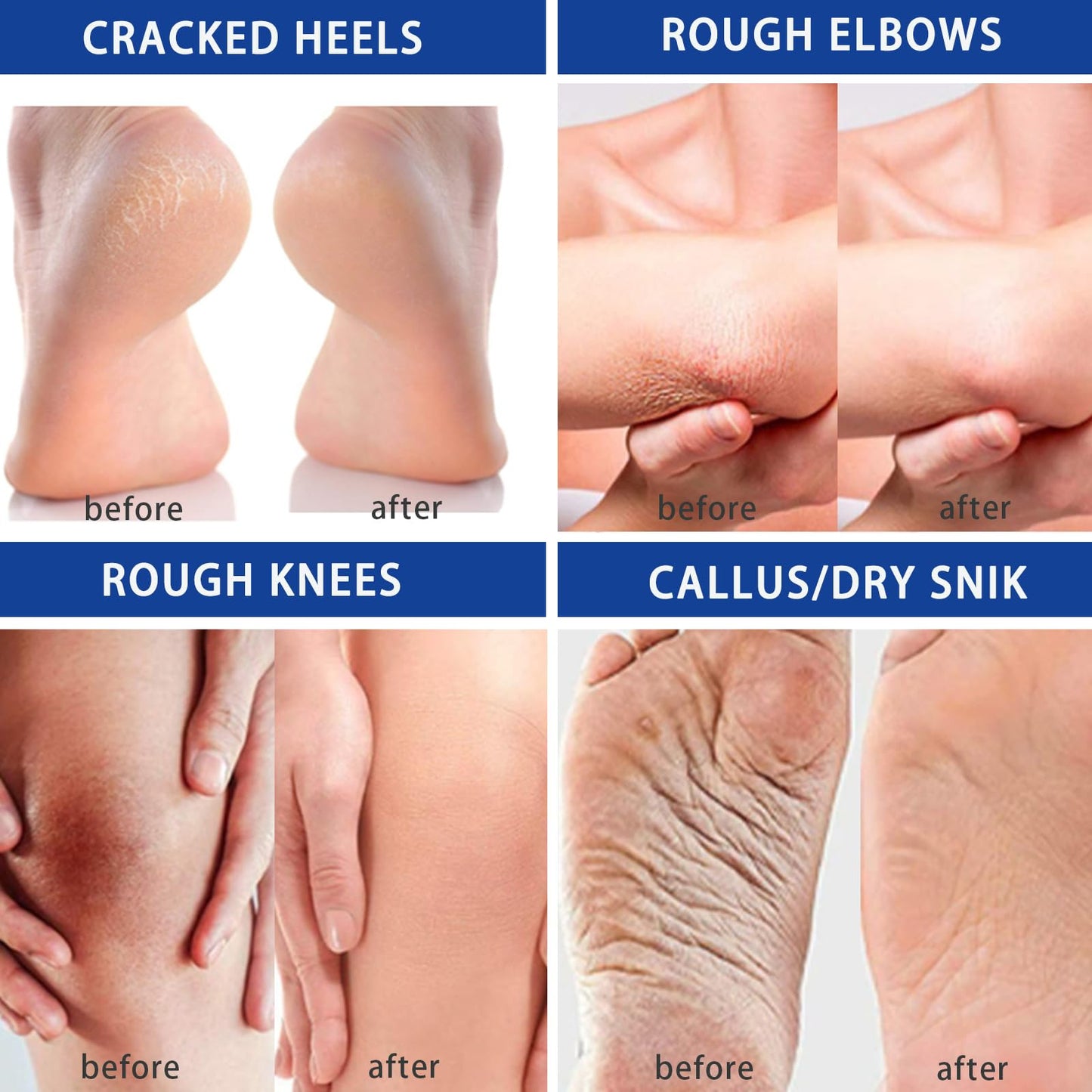 HERBINSOLS 2Pcs Urea Foot Cream - Urea Cream 60 Percent For Feet Plus 2% Salicylic Acid - Cracked Heel Repair Cream - Foot Cream For Calluses And Dry Hard Skin - Urea Moisturiser For Hand Foot Care