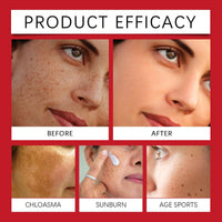 Dark Spot Remover Face Creams,Dark Spot Remover for Face & Body,Pigmentation Treatment,Age Spot Cream,Whitening Freckle Cream,Sun Spots and Melasma Treatment Creams,Fade Freckles & Improve Dull Skin