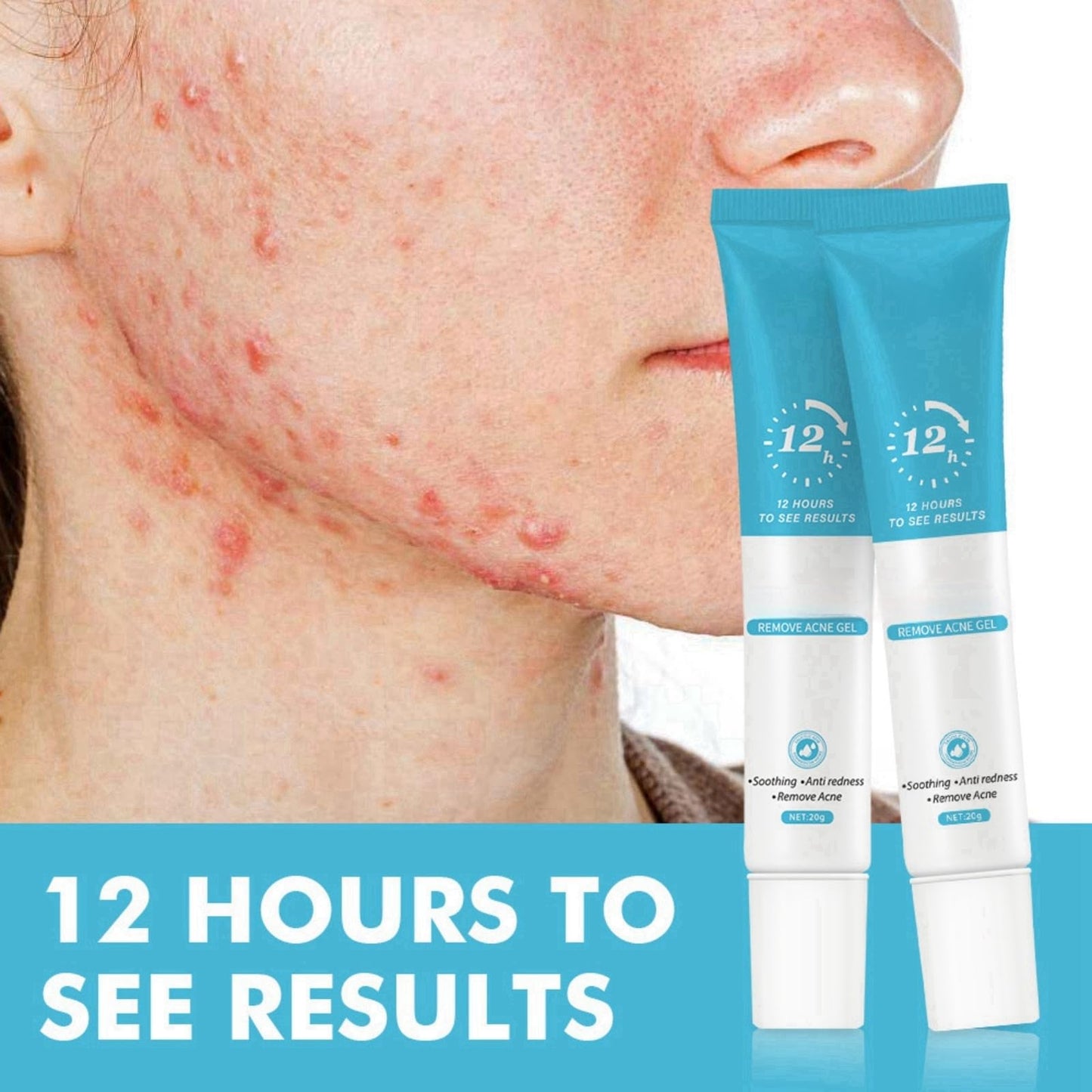 2PCS Acne Treatment Gel,Acne Cream Useful,Anti Acne Face Cream,Anti Acne Removal Cream,Acne Spot Treatment Cream,Pimple Treatment Gel Cream,Face Ance Gel,Acne Treatment Spot and Blackheads Treatment