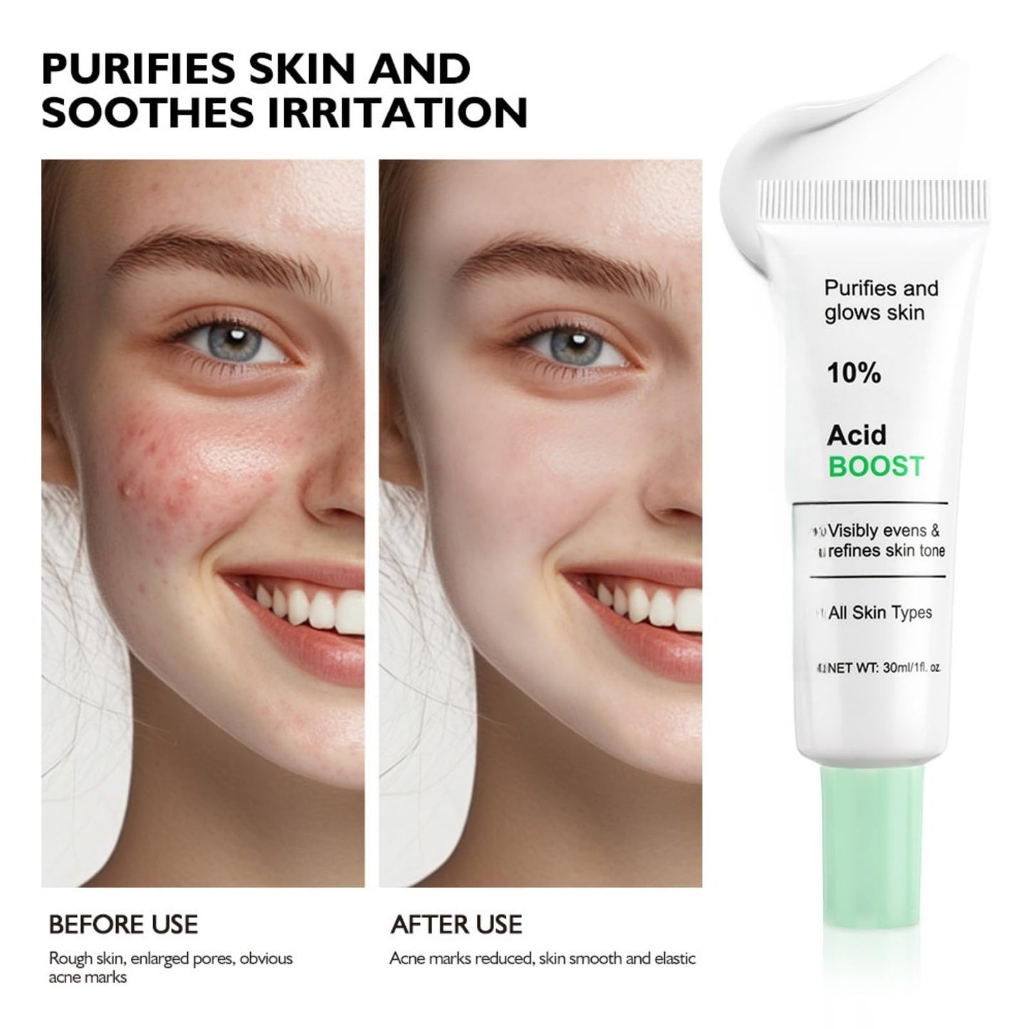 Siyinzu Acid Face Cream,10% Acid Gel For Facial and Skin Care,Ac/id 10% Acne Tratment Ge/l,Anti Acne G/el for Spot Prone Sk/in,Brightening Face S/kin Care Treatment,Dark Spot Serum Cream for Face