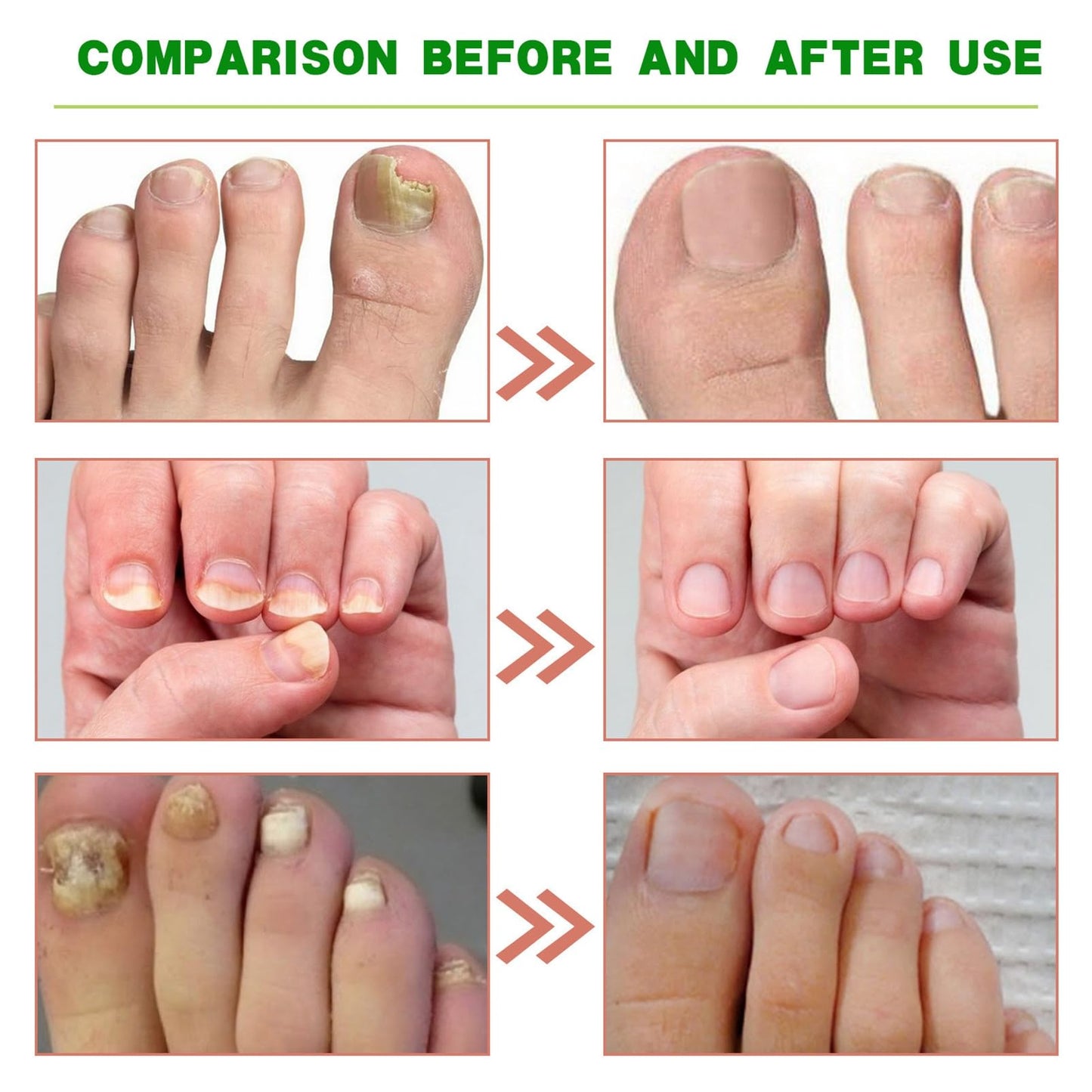 Ginger Nail Treatment Nail Support Nail Care - Ginger Nail Growth Serum, 7 Days Nail Treatment, Ginger Cuticle Care Oil for Nails, Nail Strengthener For Damaged Nails, Fungal Nail Treatment