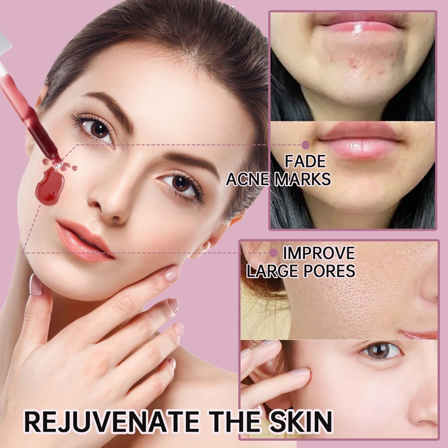 AHA BHA Exfoliating Serum for Acne, 12% AHA BHA PHA LHA Peeling Solution, Exfoliating Serum for Face, BHA Serum for Pores, Overnight Exfoliating Serum for Clear & Smooth Skin, Reduces Pore Congestion