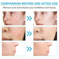 1PCS Acne treatment gel, Anti-Acne Cream, Spot Treatment Pimple Cream,Moisturizing gel for relieving and soothing redness, Acne treatment and spot treatment 20g.