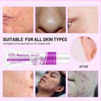 Bettinay Rosacea Cream for Face, 12% Azelaic Acid Cream, Gentle and Moisturizing for all Skin Pigmentation Redness