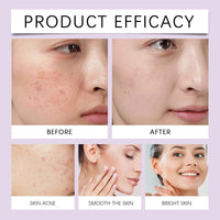 AuraBeen 12% Acid Spot Cream - Even Skin Tone, Suitable for All Skin Types - Improve Dullness, Zits, Red Dots - Zits Cream for Clearer Complexion