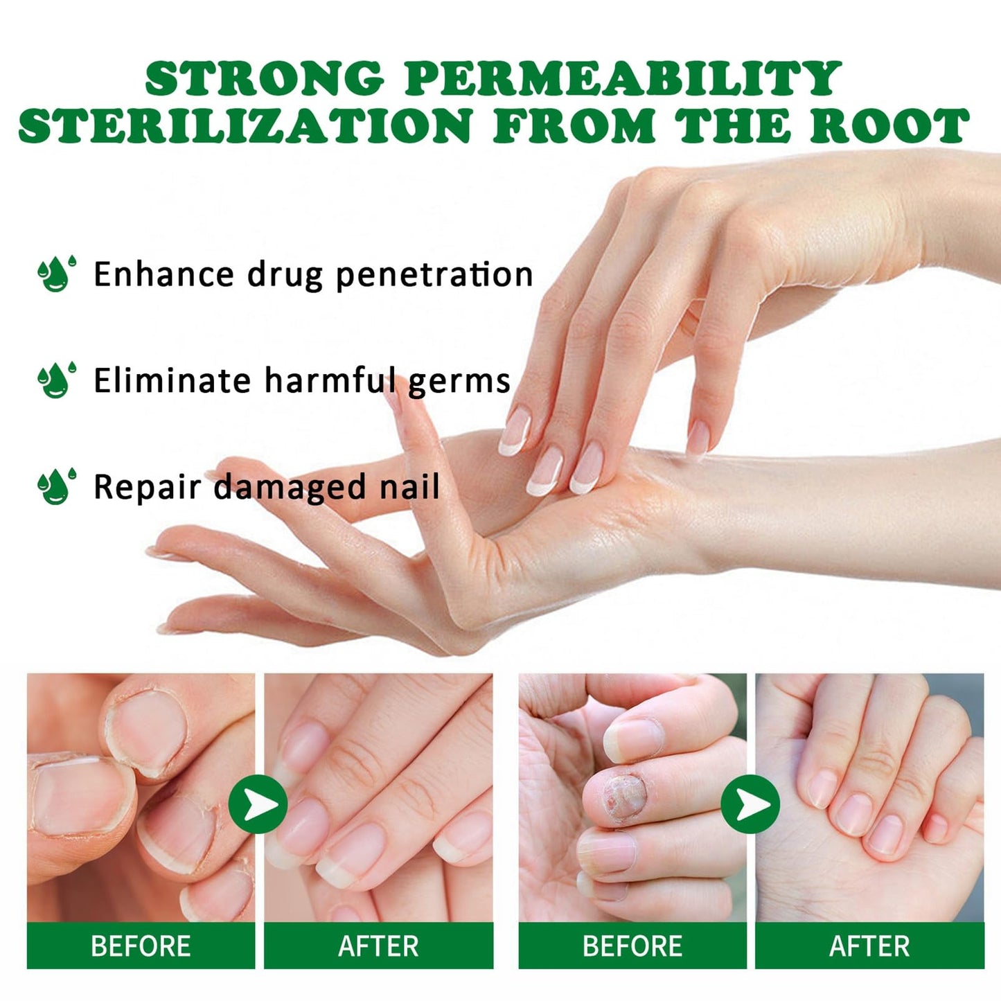 Ginger Nail Treatment Nail Support Nail Care - Ginger Nail Growth Serum, 7 Days Nail Treatment, Ginger Cuticle Care Oil for Nails, Nail Strengthener For Damaged Nails, Fungal Nail Treatment