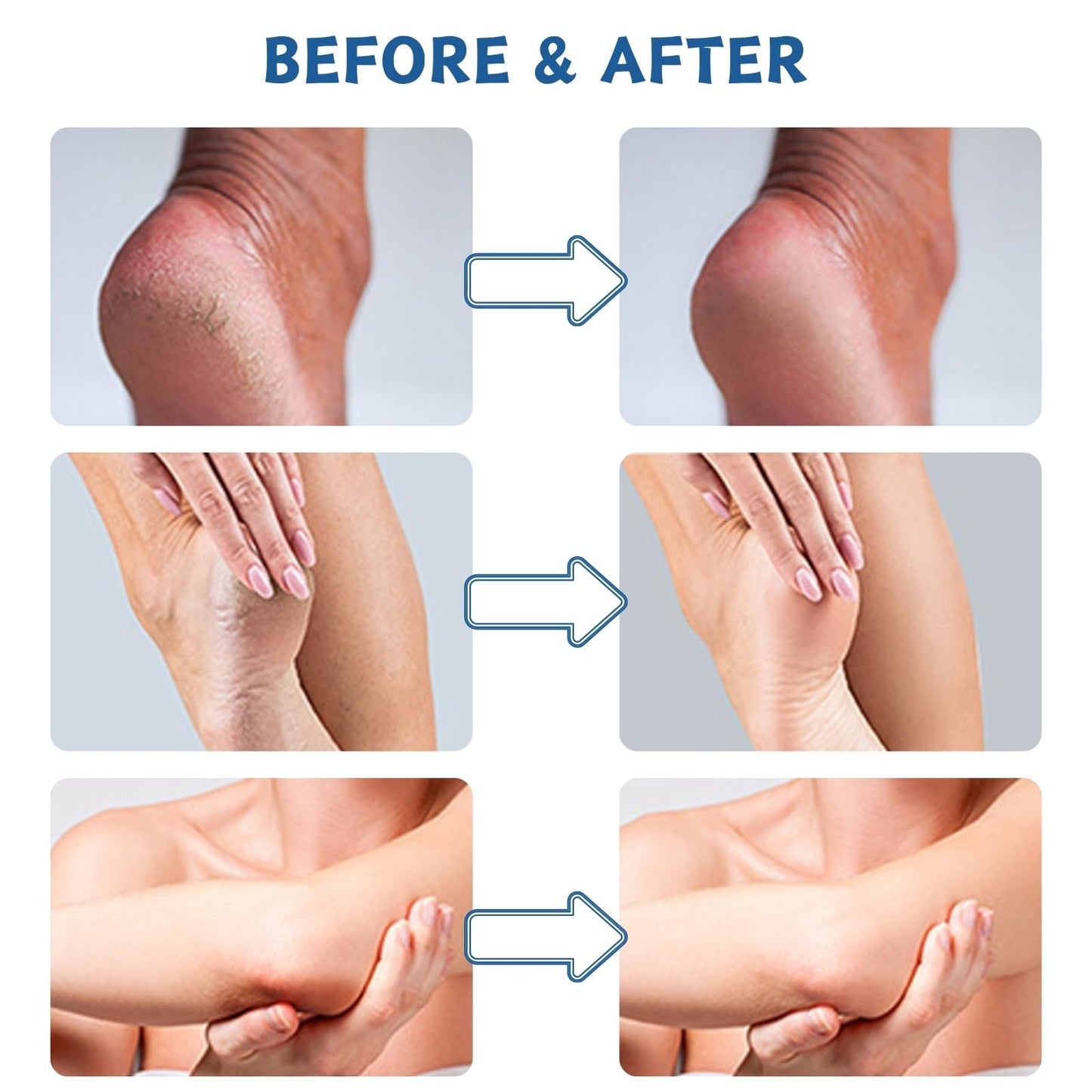 ISBEAUSOLS Urea Cream 60 Percent for Feet - Urea Foot Cream - Foot Cream for Cracked Heels and Dry Skin - Cracked Heel Repair Cream - Skin Care Hands & Feet - Foot Moisturiser 2PCS