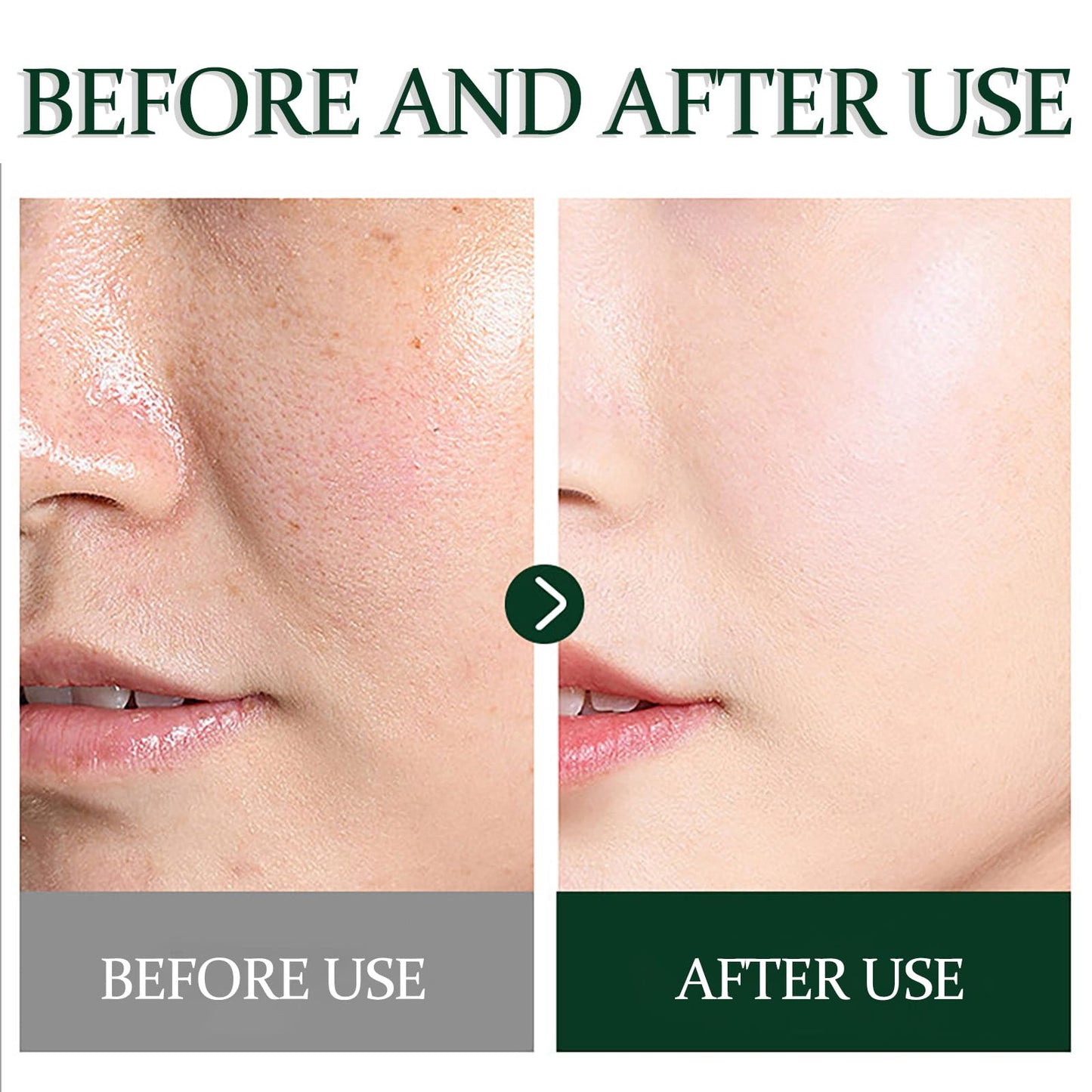 NatrLuxe Tea Tree Zits Cream 50g - Cream With Oil Control, Soothing & Moisturizing - Improve Zits & Blemishes - Clearer Skin Solution