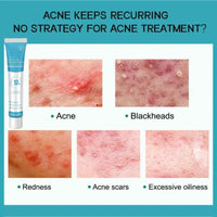 1PCS Acne treatment gel, Anti-Acne Cream, Spot Treatment Pimple Cream,Moisturizing gel for relieving and soothing redness, Acne treatment and spot treatment 20g.