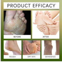 Urea Cream 60 Percent For Feet - 2PCS Urea Foot Cream For Cracked Heels And Dry Skin With 2% Salicylic Acid - Foot Cream for Cracked Heels and Dry Skin Cracked Heel Repair Cream Foot Moisturiser Balm