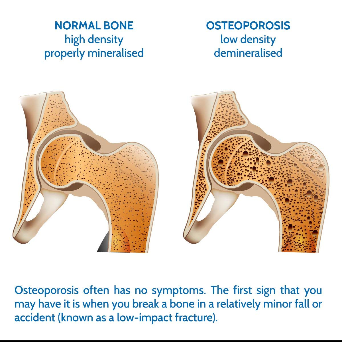 Densiboost Bone Remineralisation 60 Capsules (not Tablets) with Calcium, Magnesium, Manganese, Phosphorus, Copper, Boron, Zinc and Vitamins D3 and K2 MK-7. Made in The UK by Health4All