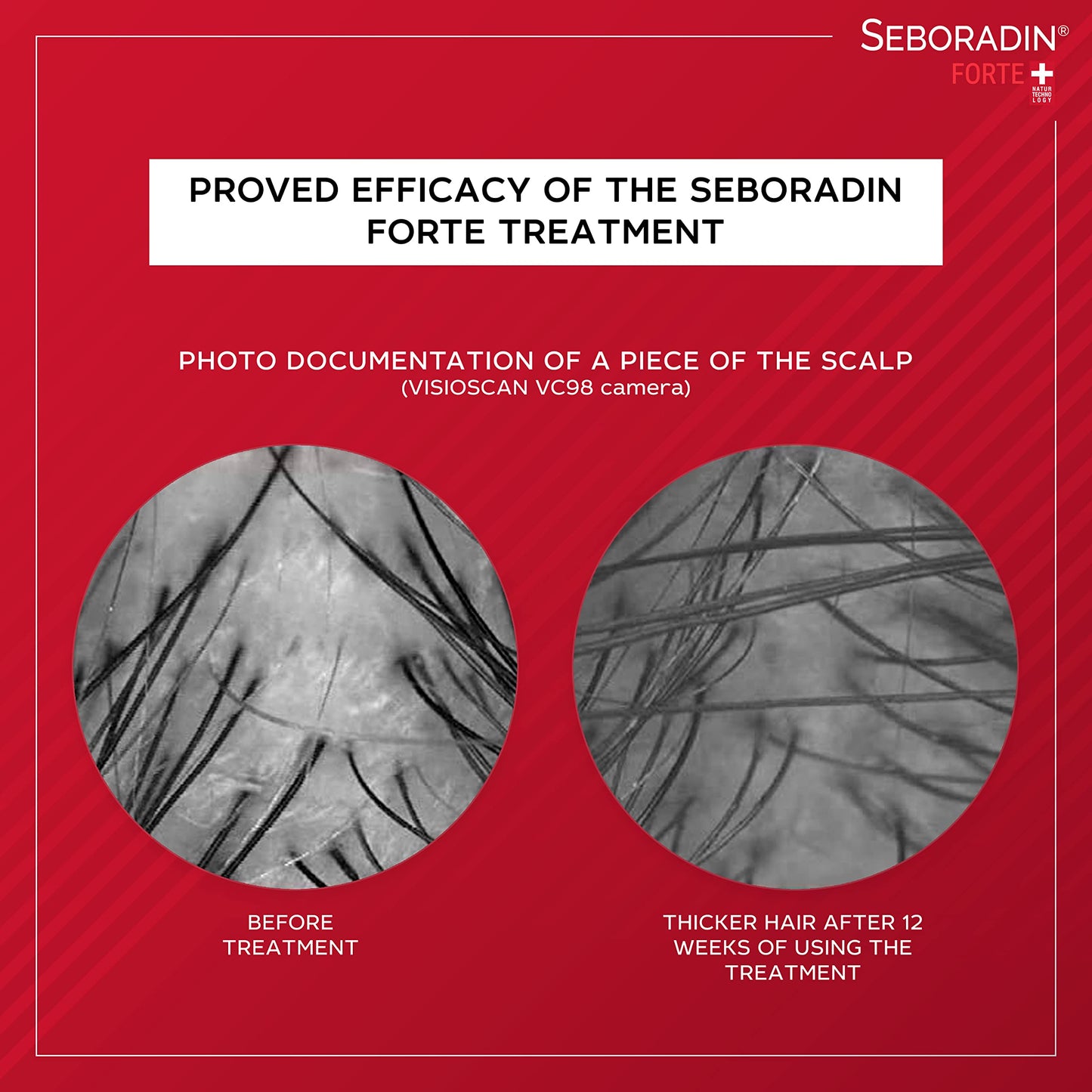 Seboradin Forte Hair Growth Serum Ampoules 28 x 5,5 ml Anti Hair Loss Serum Chronic Hair Loss and Thinning Treatment Natural Extracts and Vitamins Hair & Scalp Treatment Hair Care & Products