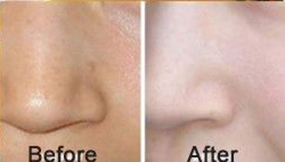 Luxurious 24k Gold Bio-collagen Facial Mask (5pcs)