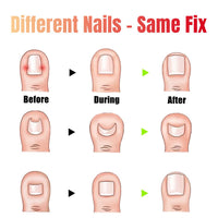 Jinbaetad Ingrown Toenail Correction Treatment Kit with 12 Pcs Ingrown Toenail Correction Pad Recover Clips Ingrown Toenail Corrector Straightener Strips for Women Men's Nail Treatment Pedicure Tool (4 Pcs Set)
