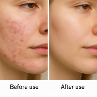 Golden Future Anti-Acne Revitalising cream , Targeted spot Treatment , pimple reducer with precision Applicator 20g