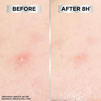 Garnier Blemish Patches, Hydrocolloid patches to reduce the appearance of spots in 8 hours, Ultra-thin & Invisible on all skin tones, Suitable For All Skin Types, Vegan Formula, 22 Patches