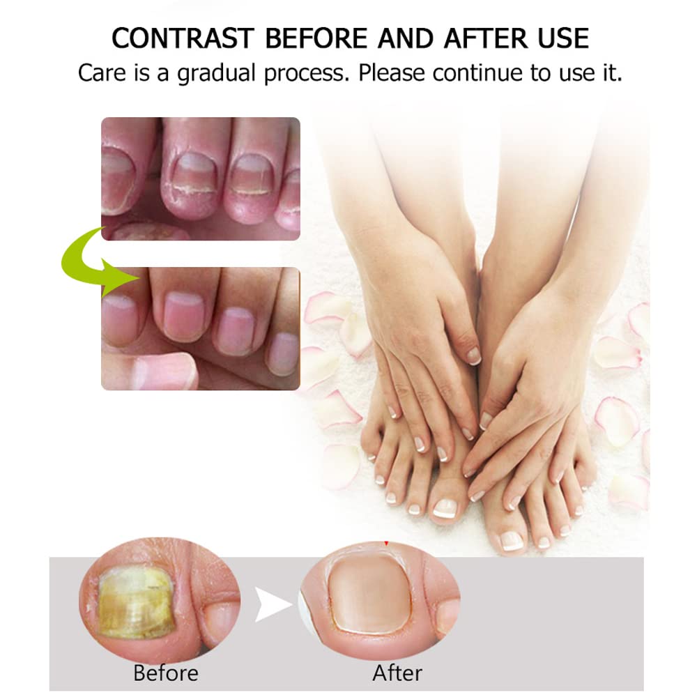 ZDHSOY Nail Repair - Nail Treatment Repair Gel/Nail & Toenail Treatment Nail Repair Cream/Toe Be Health Instant Beauty Cream, Renews Yellow, Cracked, Damaged and Split Nails