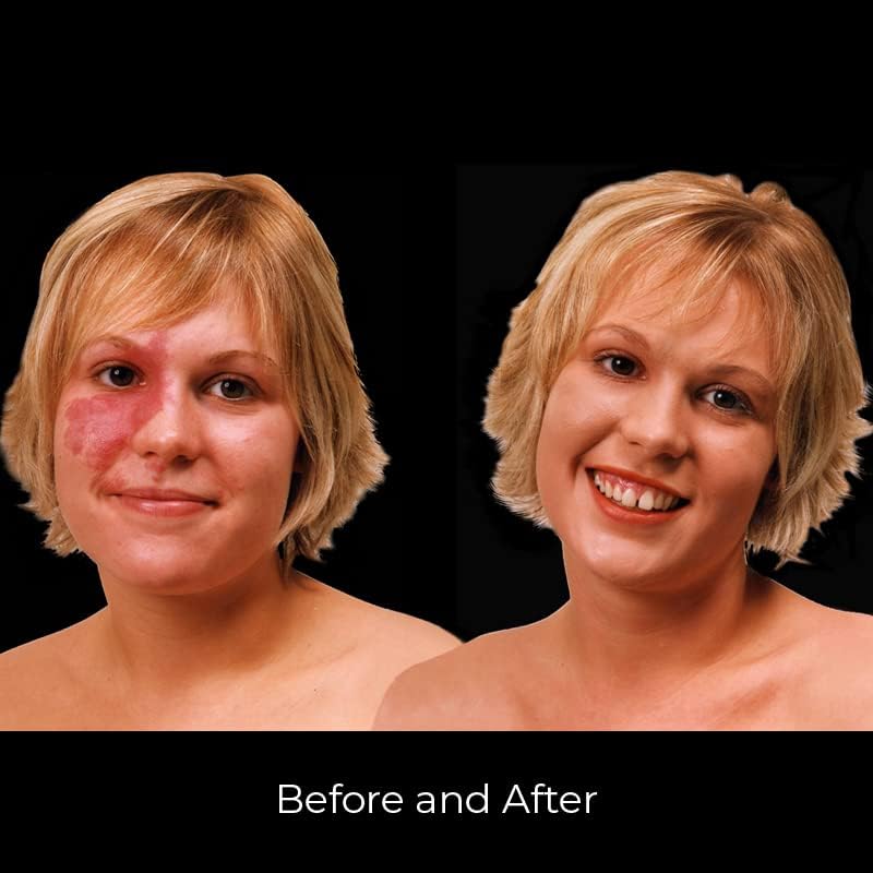 Keromask Full Coverage Hypoallergenic Concealer Shade LIGHT No 1 to Camouflage Vitiligo, Tattoos, Redness and Rosacea, Waterproof and Suitable for All Skin Types 1 x 15ml