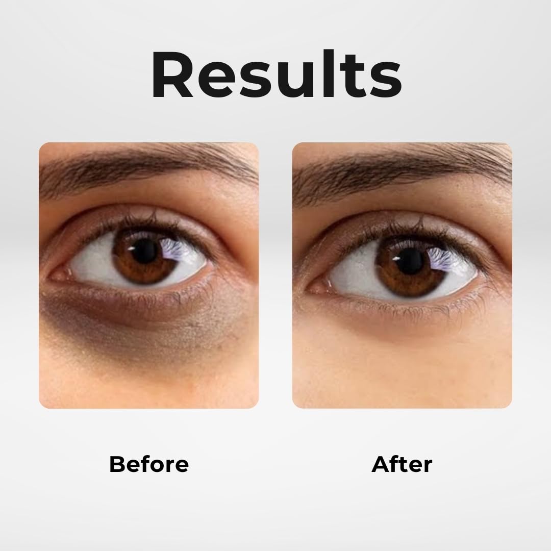 Lashfactor Under Eye Gel Serum- Hydrating Eye Serum for Dark Circles, Puffy Eyes, Eye Bags - Eye Bags Remover - 96% Users Reported a Reduction of Dark Circles,30g (Pack of 2)