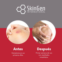 HEMATIX Hematix Bruise Cream - 15g - Clinically Proven Advanced Healing Formula with Glycerol and menthol for Bruise Prevention - High Strength Natural Anti Bruise Treatment Balm Gel for Healing