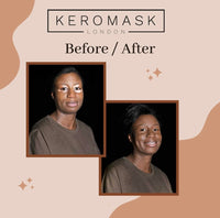 Keromask Full Coverage Hypoallergenic Concealer Shade LIGHT No 9 to Camouflage Vitiligo, Tattoos, Redness and Rosacea, Waterproof and Suitable for All Skin Types 1 x 15ml