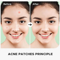 Generic Vivid Acne Patches - Pack of 36 Translucent Hydrocolloid Pimple Patch Spot Treatment Stickers (Tea Tree Oil) for Face and Body- Fast-Acting, Vegan & Cruelty Free Skin Care