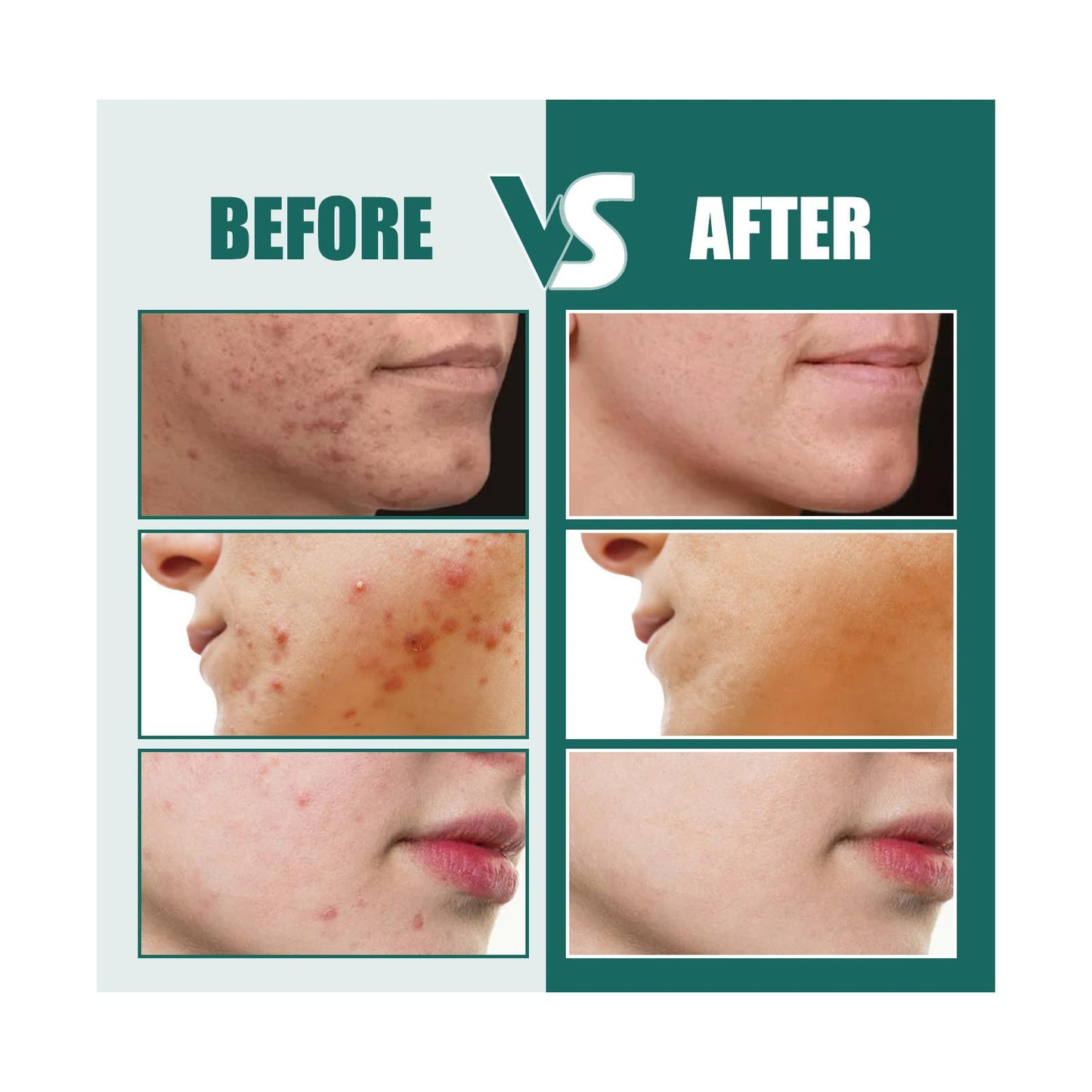 LIDOUK 12mm and 8mm spot patches, acne patches, star shaped, water-based gel patches for acne, blemishes, cyanosis, and facial acne patches (112 patches)