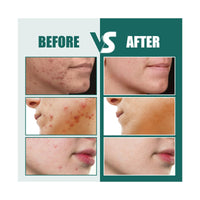 LIDOUK 12mm and 8mm spot patches, acne patches, star shaped, water-based gel patches for acne, blemishes, cyanosis, and facial acne patches (112 patches)