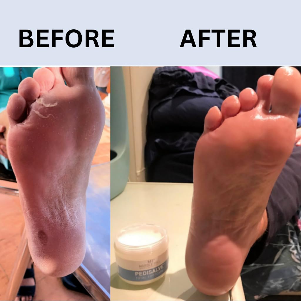 PediSalve Foot Cream Fast Relief Very Dry Feet Hard Skin. Cracked Heels Diabetic Foot Care, Eczema. Shea butter Vit E. Developed by Medical Doctor Marble Hill 100g