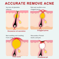 Acne Treatment Cream – Fast Acting Spot Treatment for Face - Blemish Control Cleanser Reduces Pimples, Blackheads & Blemishes - Gentle Skin Care for Oily & Acne-Prone Skin, 40g (2 Value Packs)