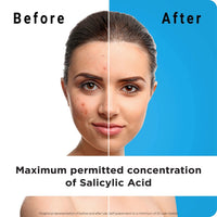 Generic Exfoliating Face Wash with Salicylic Acid (Pack of 3) - Visible Results from Day 1 | Purifies & Unclogs Pores, Reduces Oil & Shine | Cruelty Free & Dermatologically Approved