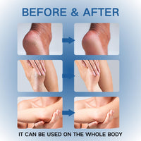 Urea Foot Cream 42% - Foot Cream - Foot Cream for Cracked Heels and Dry Skin - Cracked Heel Repair Cream for Hand and Feet - 42% Urea Cream & 2% Salicylic Acid for Callus Remover & Nourishes Soften