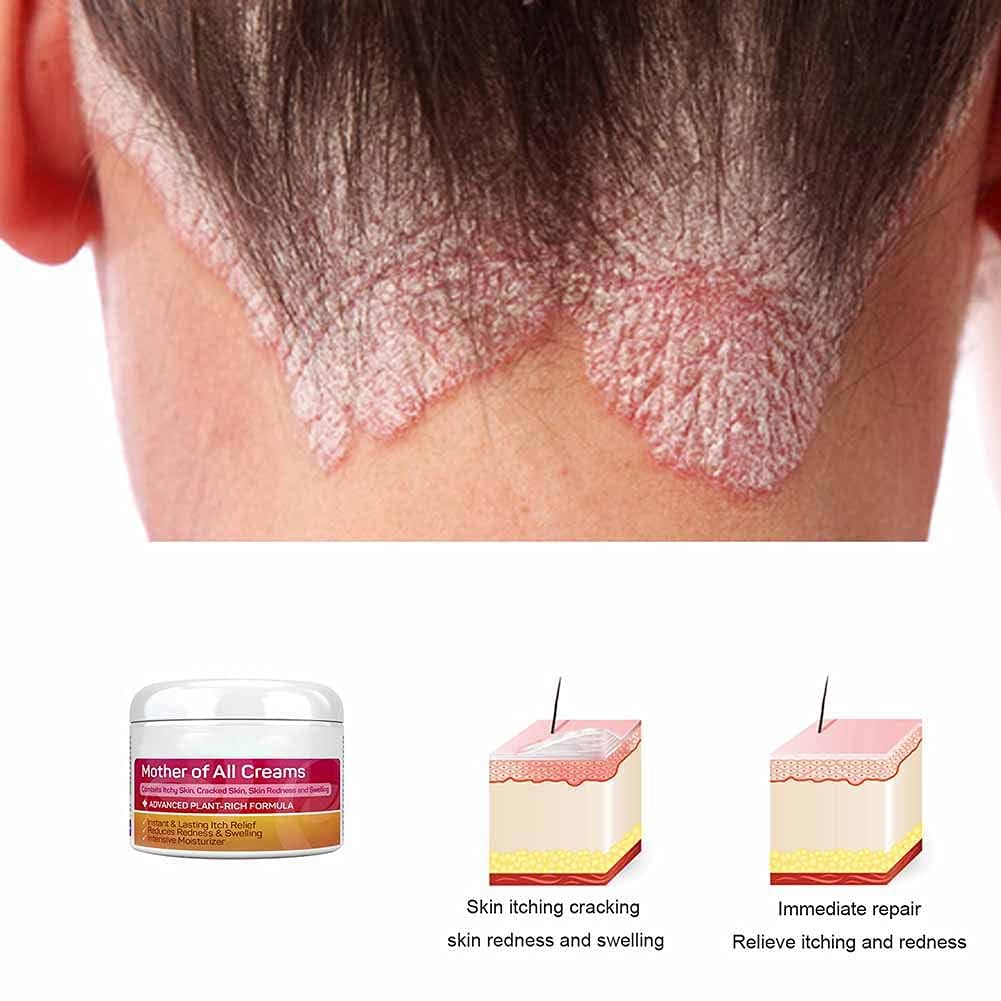 Allbestaye Skin Psoriasis Cream Dermatitis And Eczema Eczema Ointment Treat Dry, Itchy And Sensitive Skin, Face And Body Care Skin Redness And Rash