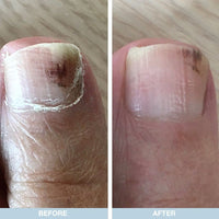 Australian Bodycare Feet and Nails Care Kit with Tea Tree Oil - Foot Cream, Heel Repair, and Nail Repair for Softer, Healthier Feet and Nails - Moisturizes, Soothes, and Repairs Dry and Cracked Heels