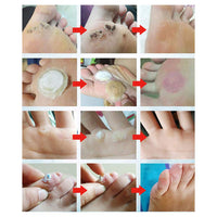 GNAPY Wart Removal Plasters, 24Pcs Wart Remover for Hands Feet Corn Removal Plaster with Hole, Remover Plantar Warts, Callus, Stops Wart Regrowth (A)