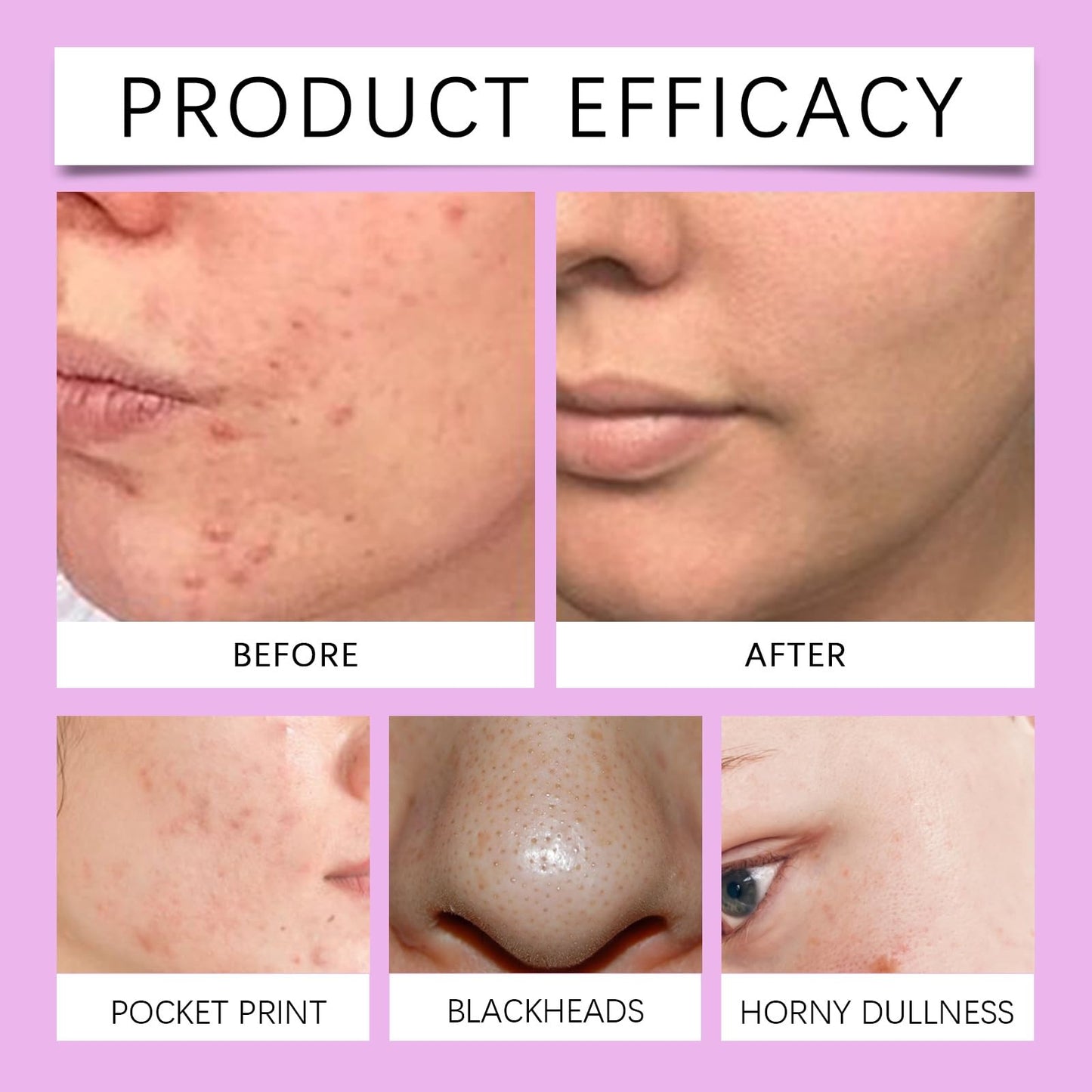 Acid 12% Facial Serum,Anti Acne Cream Face Serum,Aze/laic Aci/d for Anti Acne,A/cid Face Spot Treatment,Night Cr/eam Face Moisturiser,Skin Care Gel, A cne C/ream Skin Care,Acid Serum