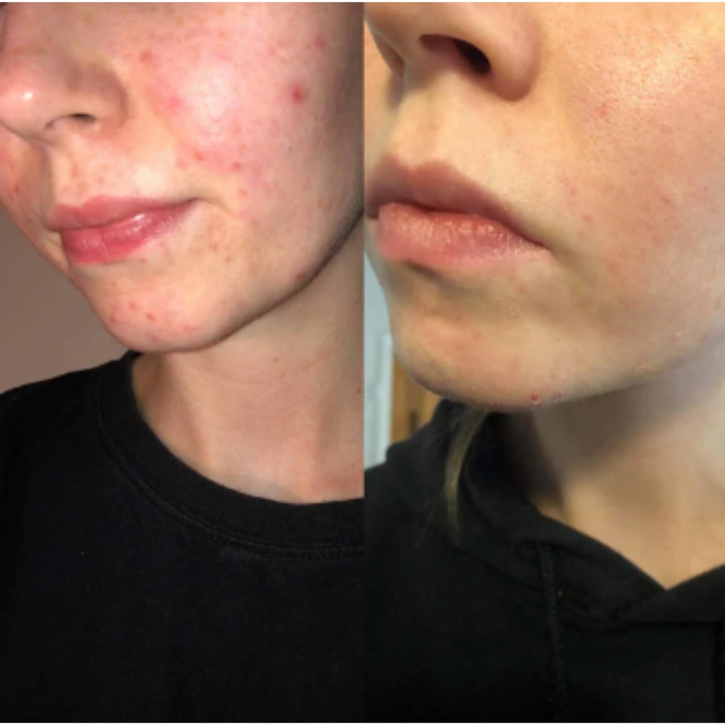 Dermz Acne Treatment - Acne Cream, SPF Face Protection, Face wash & Toner - Set of 4