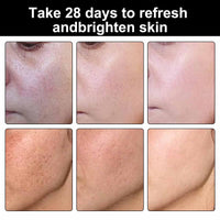 Mxlfdc Dark Spot Remover for Face，-Age Spot Remover -Hyperpigmentation Treatment-Sun Spots and Melasma Treatment Cream for Face, Pigmentation Freckle Removal Cream