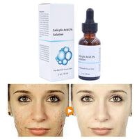 Salicylic Acid Concentrate Super Strong 2% - Acne Spot Treatment - Professional Skincare Serum