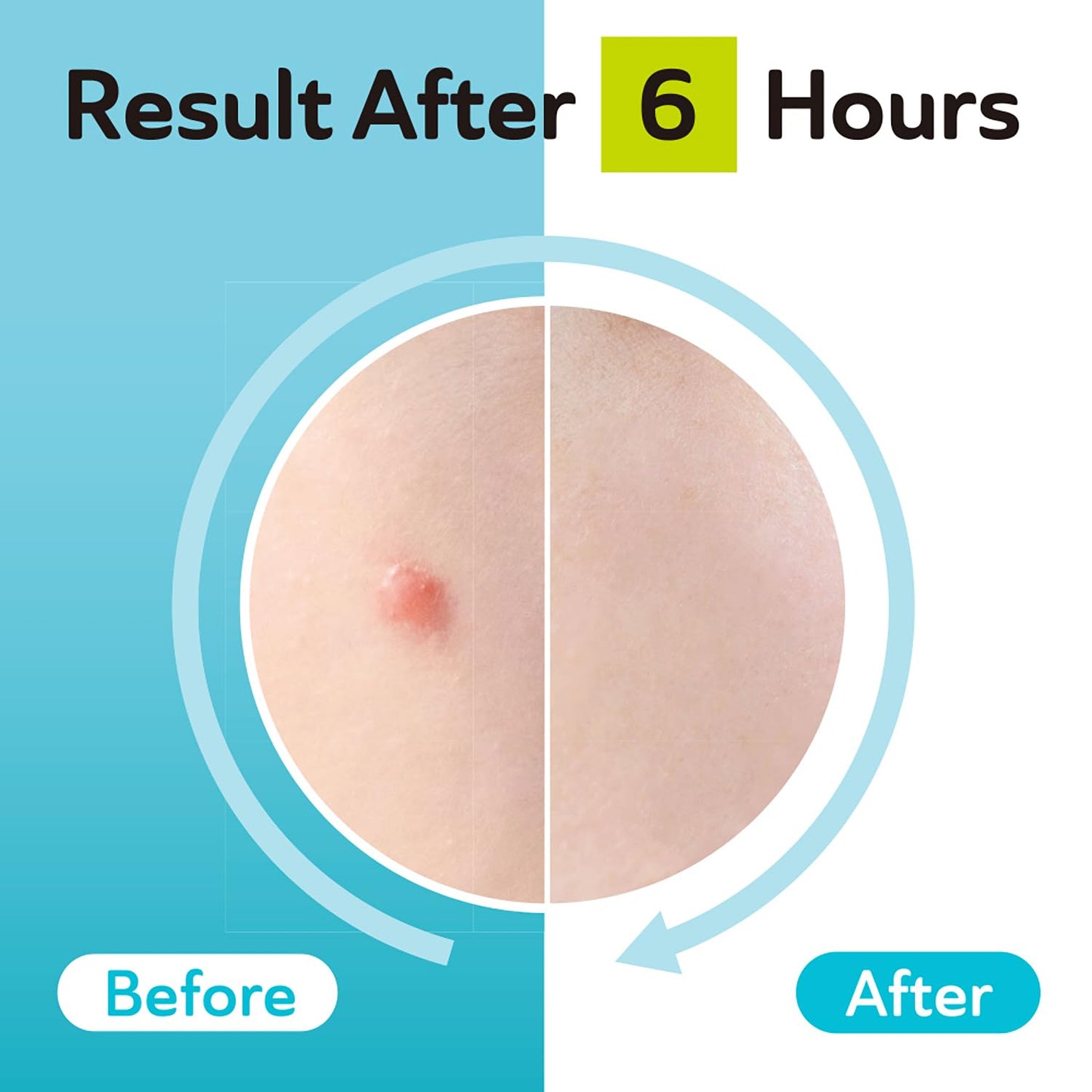 DERMA ANGEL Derma Angel Ultra Thin Hydrocolloid Acne Day Patches for Surface Pimples (24 Pieces) | Absorbs Fluid and Covers Spots | Matte Finish Blends Under Makeup