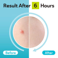DERMA ANGEL Derma Angel Ultra Thin Hydrocolloid Acne Day Patches for Surface Pimples (24 Pieces) | Absorbs Fluid and Covers Spots | Matte Finish Blends Under Makeup