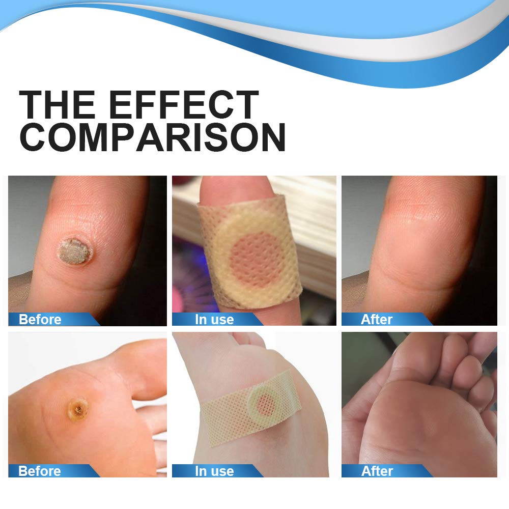GNAPY Wart Removal Plasters, 24Pcs Wart Remover for Hands Feet Corn Removal Plaster with Hole, Remover Plantar Warts, Callus, Stops Wart Regrowth (A)