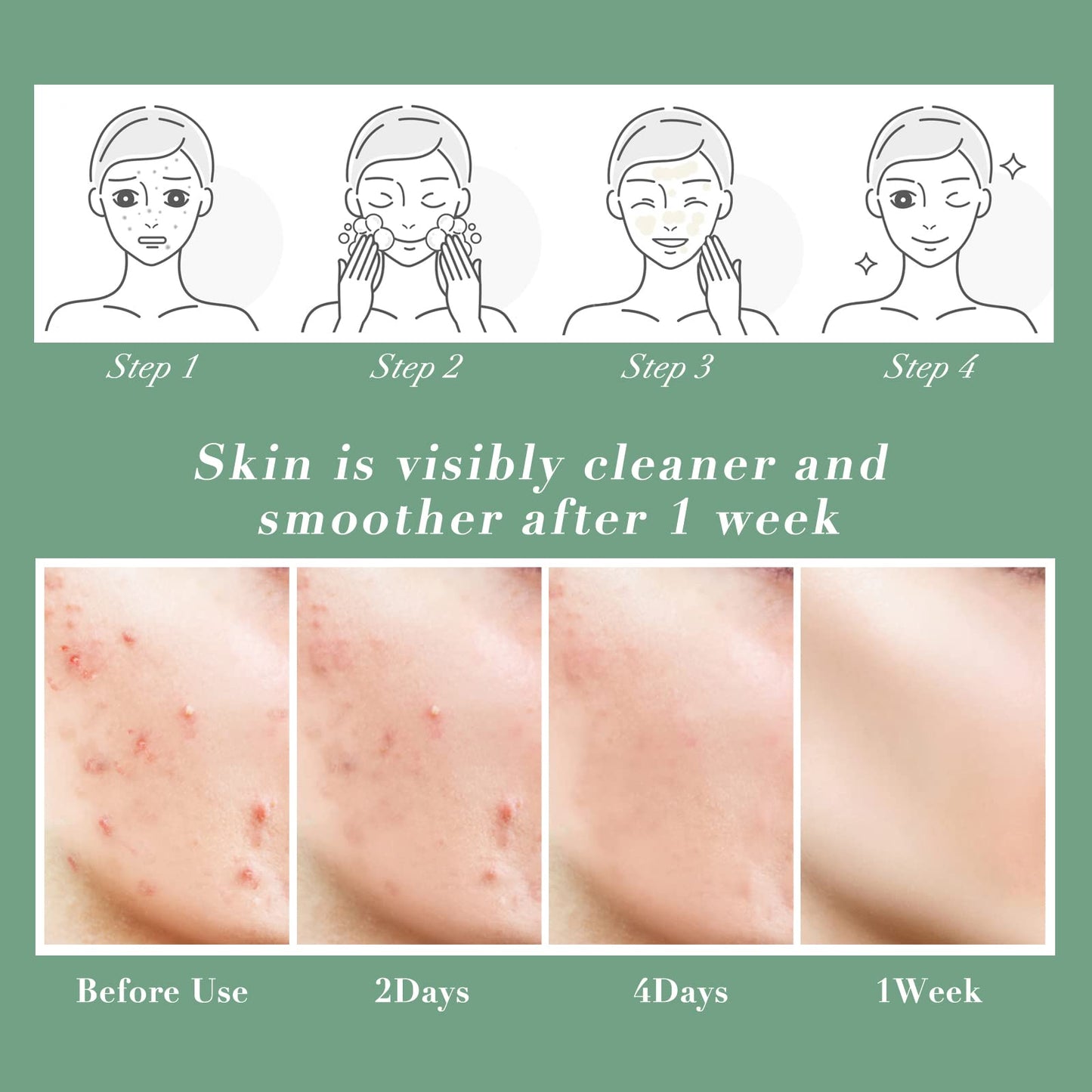 Acne Spot Treatment Cream Aliobio for Acne Scar Pimple Cream for Face & Back Acne Anti-Blemish Care 60g, yellow