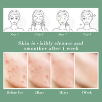 Acne Spot Treatment Cream Aliobio for Acne Scar Pimple Cream for Face & Back Acne Anti-Blemish Care 60g, yellow